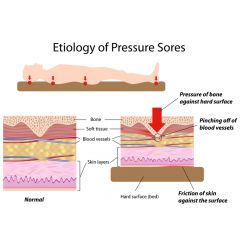 OWC006c - Overview of Pressure Ulcer Etiology - Part 3