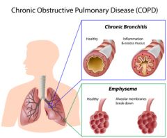RESP010 - Intervention and Strategies for the COPD Population