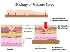 OWC006a - Overview of Pressure Ulcer Etiology - Part 1