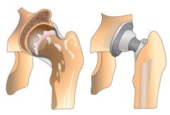 REHB027  Overview of Joint Replacement