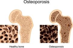 DMGT007 - Overview of Osteoporosis