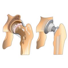REHB027  Overview of Joint Replacement