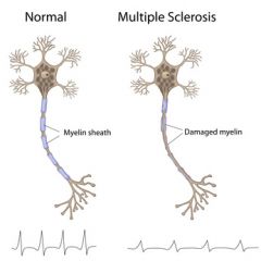 DMGT015 - Overview of Multiple Sclerosis