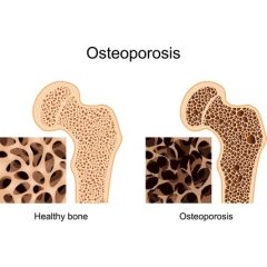 DMGT007 - Overview of Osteoporosis