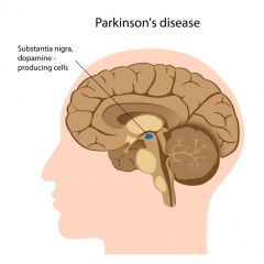 DMGT014 - Overview of Parkinsons Disease